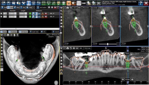 Radiografii 3D CRANEX3D